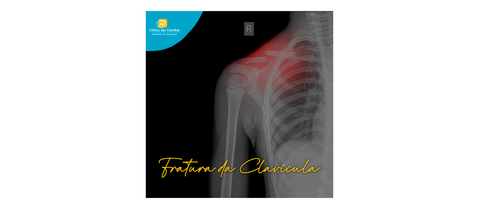 Sabia que uma fratura da Clavícula representa 4% de todos os tipos de fratura e 35% de todas as lesões no ombro?